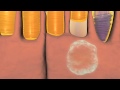 Animation of Wet and Dry Macular Degeneration