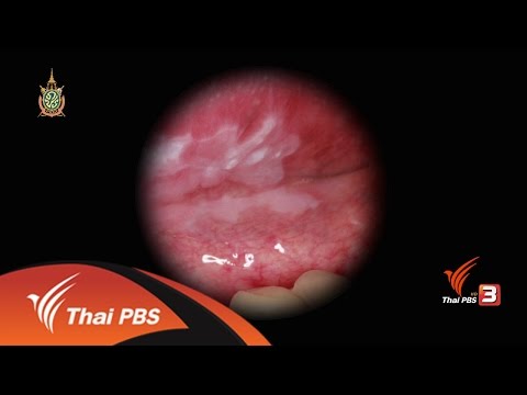 โรคสะเก็ดเงินรักษา belosalik ครีม โรคสะเก็ดเงิน pustular รูปภาพ tsumbusha