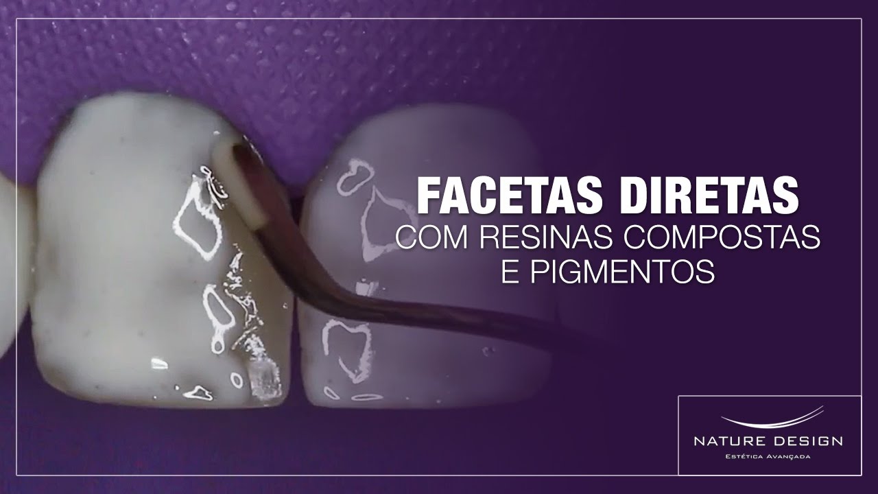 Facetas Diretas com Resinas Compostas e Pigmentos | Leonardo Muniz