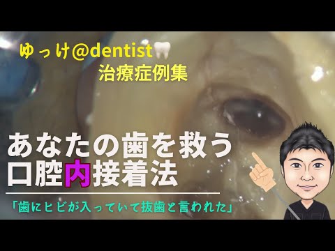 生命歯学科 ゆっけ＠dentist🦷治療症例集　口腔内接着法　「歯にヒビが入って残せない」そう言われた方必見！歯を保存するための接着治療とは