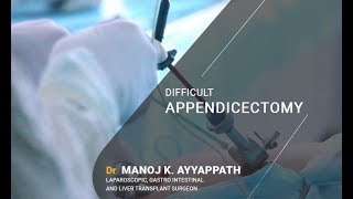 Laparoscopic Difficult Appendicectomy