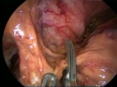 Azagra & Goergen: Laparoscopic Distal Pancreatectomy