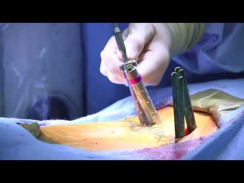 Minimally Invasive Transforaminal Lumbar Interbody Fusion Surgery