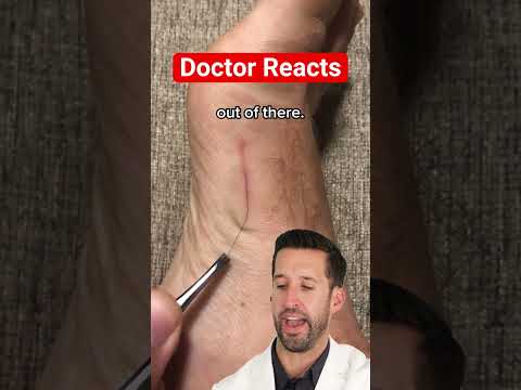 ER Doctor REACTS to "Satisfying" Hair Splinter Removal