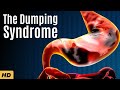 The Dumping Syndrome: Everything You Need To Know