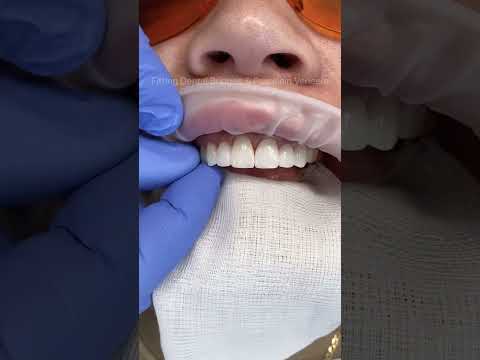 A combination of porcelain bridges & veneers to replace missing teeth & create a wider smile 🤍