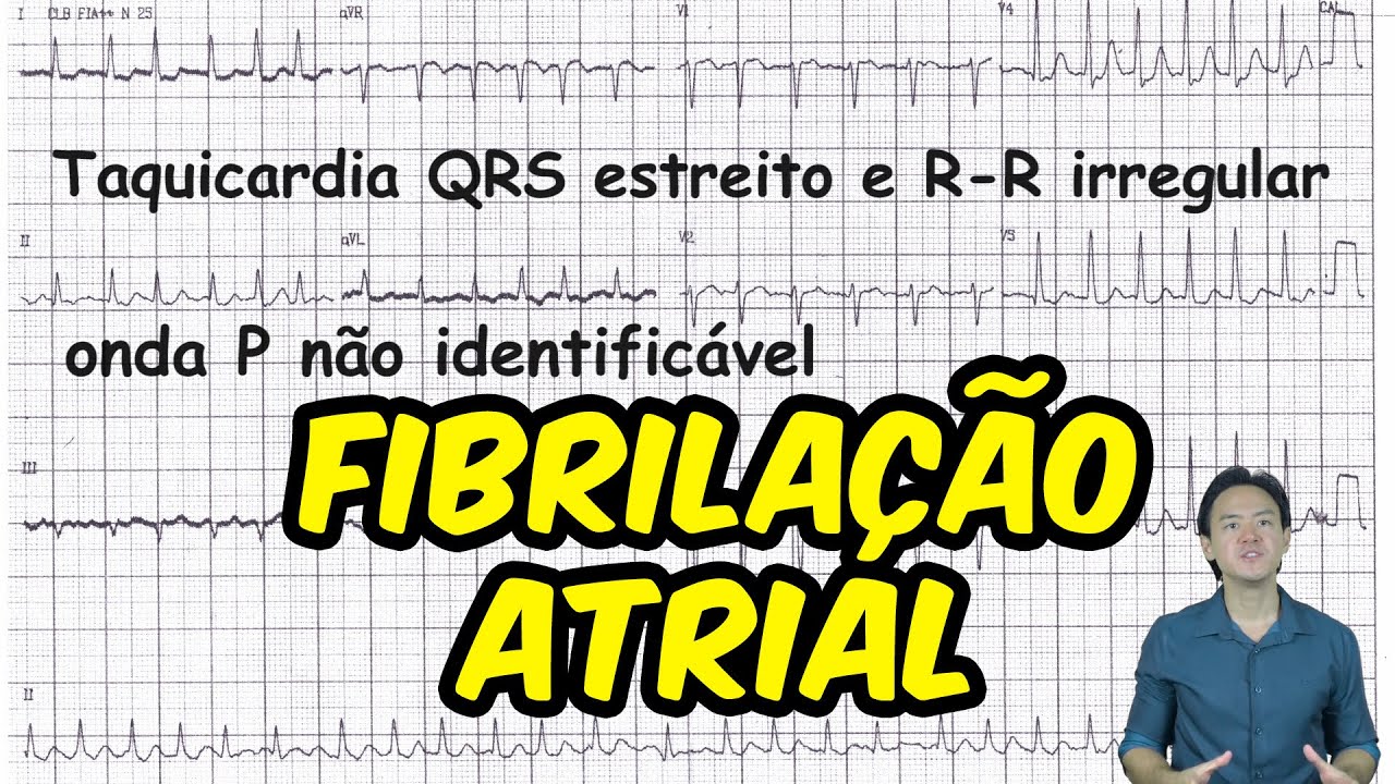 Eletrocardiograma - análise - Fibrilação atrial