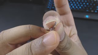 Removing Dead Infected Skin From Finger