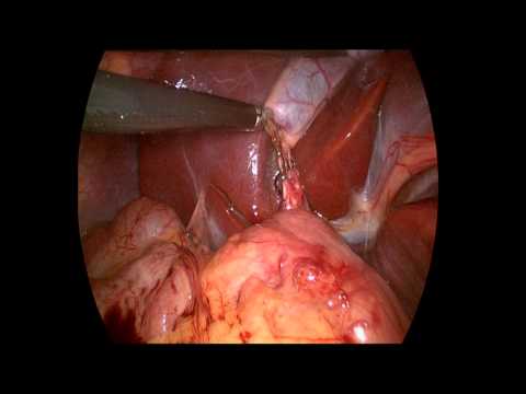 Laparoscopic Cholecystectomy