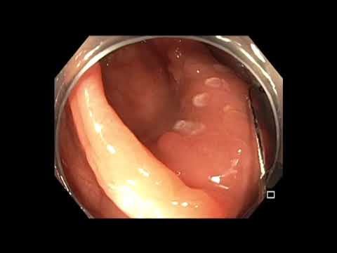 Colonoscopy: Cecum Tethered Polyp - Subtle Colon Polyp - Hot Snare Resection