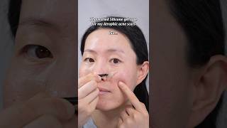 Silicone gel tape working for Atrophic acne scars❓#acnescars #acne #scars
