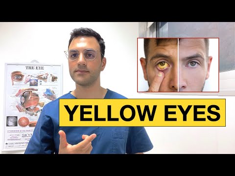 Why Are My Eyes Turning Yellow? | Scleral Icterus Explained by Dr. Neo Mavris