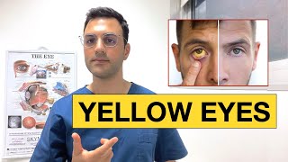 Why Are My Eyes Turning Yellow | Scleral Icterus Explained by Dr. Neo Mavris