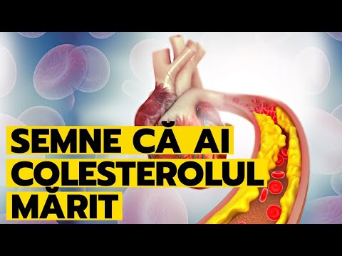 Ai colesterolul mărit? Semne care îți indică valorile crescute