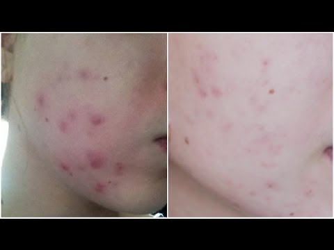 comment traiter naturellement l'acné