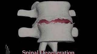 Spinal Degradation