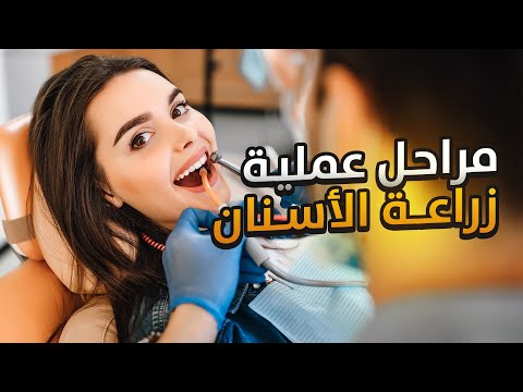 مراحل عملية زراعة الأسنان - مركز استانوفا تركيا اسطنبول