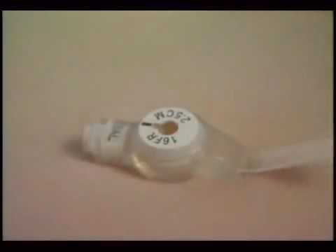 MIC-KEY Tube Feeding Procedure