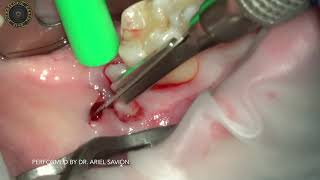 EXTRACTION IMPACTED WISDOM TOOTH UNDER MICROSCOPE  BY DR. ARIEL SAVION
