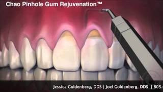 preview picture of video 'Gingival Graft Surgery (Ventura, CA) - Goldenberg Family Dentistry'