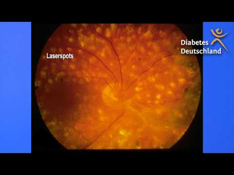 Geräte zur Behandlung des diabetischen Fuß Hypoglykämischen Gras in Typ-2-Diabetes