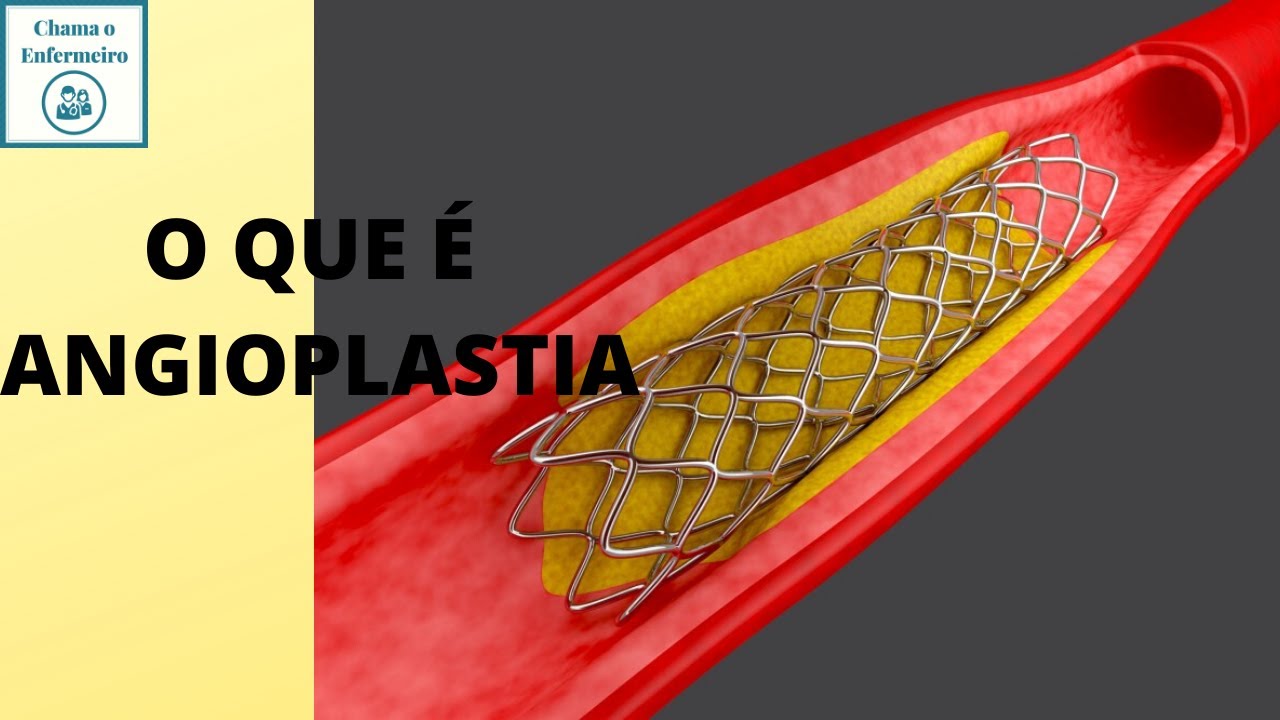 O que é Angioplastia parte 1