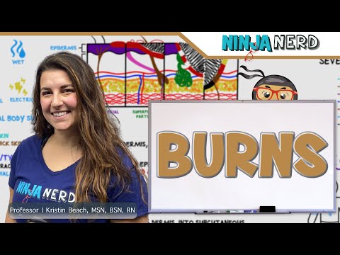 Burns 🔥