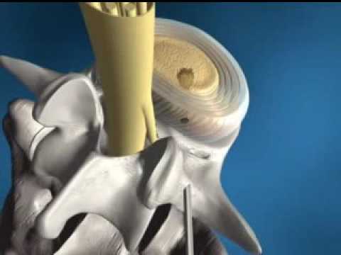 Wie lange kann als Osteochondrose geheilt werden Übungen für Rückentrainingsvideos für Hüfte