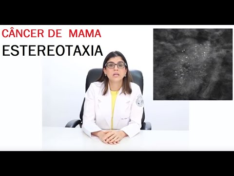 Câncer de mama - localização de lesões mamárias por estereotaxia