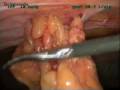 Laparoscopic Umbilical Hernia Repair 
