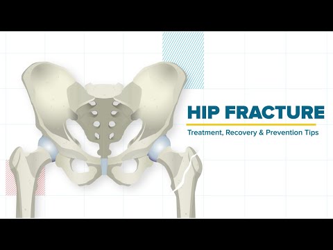 Hip Fracture - Treatment, Recovery & Prevention Tips