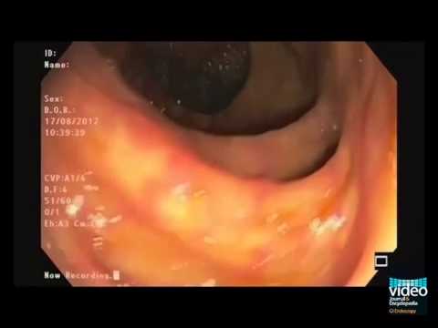 Normal Adult Colonic Anatomy in Colonoscopy