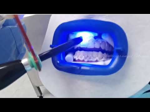 In Office Teeth Whitening
