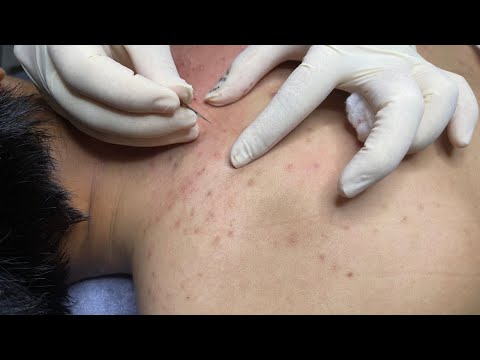 ACNE TREATMENT WITH VU QUYNH MI| Acne Squeeze For...