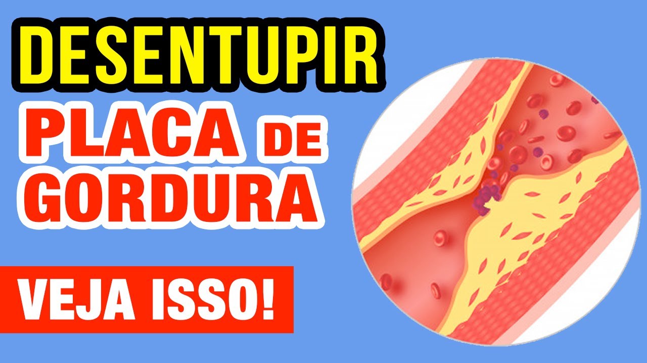 Como DESENTUPIR AS ARTÉRIAS - Eliminar "Placas de Gordura" que se Acumulam (Aterosclerose)