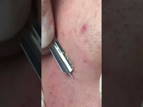 Face Blackheads Removal