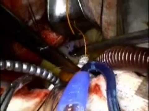 Minimally Invasive Aortic Valve Replacement Surgery and Septal Myectomy