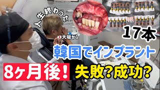 韓国でインプラント17本！8ヶ月後、失敗？成功？
