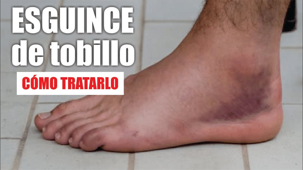 ESGUINCE o TORCEDURA de TOBILLO 🦶🏼 Tratamiento De Rotura De LIGAMENTOS De Tobillo ⭐ Dr EDSON SERRANO