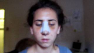 My Rhinoplasty Recovery: #4