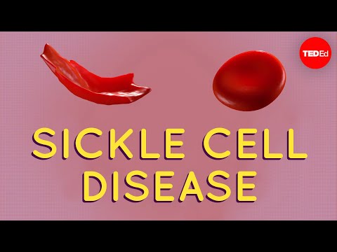 How Sickle Cell Disease Developed and Its Treatment