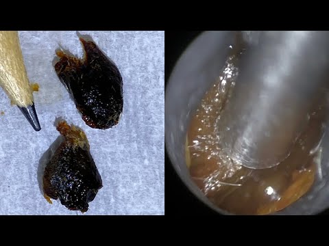 52 - Extra Large Ear Wax Plugs Removed using WAXscope®️