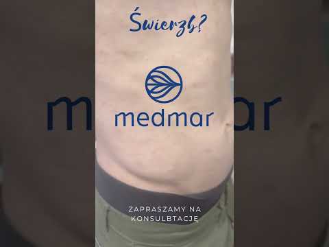 Świerzb jest chorobą, którą można się zarazić się nawet w dobrych hotelach i ekskluzywnych wakacjach