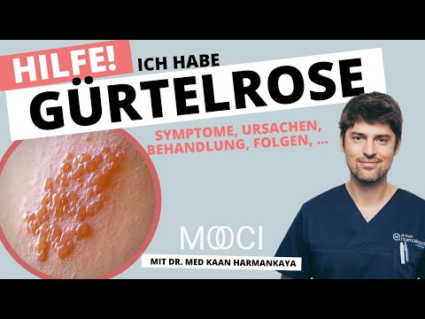 Gürtelrose 😱  Symptome, Behandlung, Ansteckung von Herpes Zoster