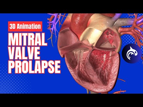 Mitral Valve Prolapse - 3D Animation