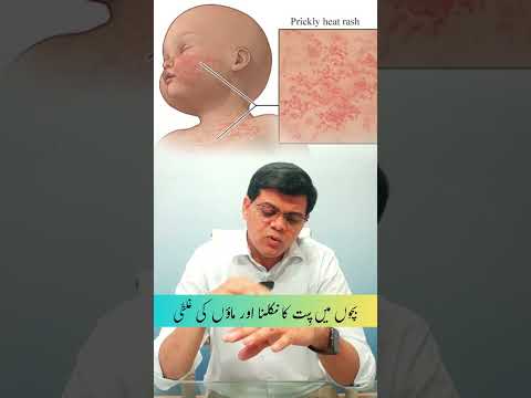 Bachon Ma Garmi dane - garmi dano ka ilaj - garmi dane or kharish ka ilaj #ytshorts #drshoaibsabir