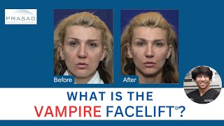Vampire Facelift™: Not Just PRP Not a Facelift Replacement
