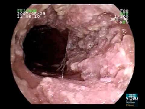Ovarian cancer abdominal nodules