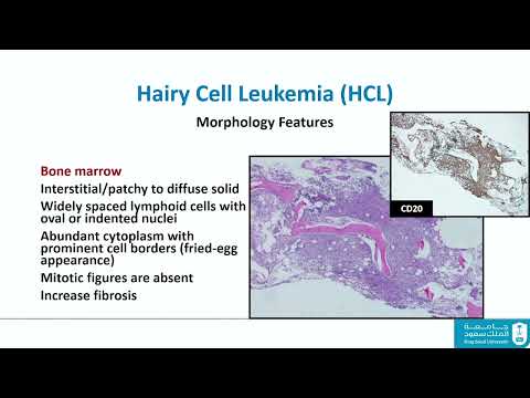 Splenic B cell lymphoma/leukemia – Dr. Khalid Alayed (September 15-16, 2023)