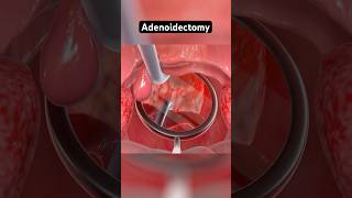 Download lagu Adenoidectomy explained (3D Animation) mp3 Download lagu Adenoidectomy explained (3D Animation) mp3
